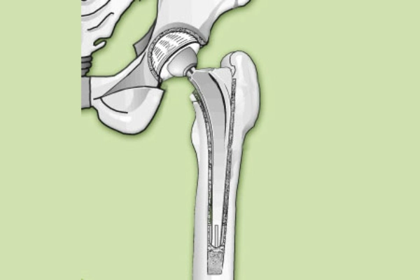 What is an Artificial Hip?