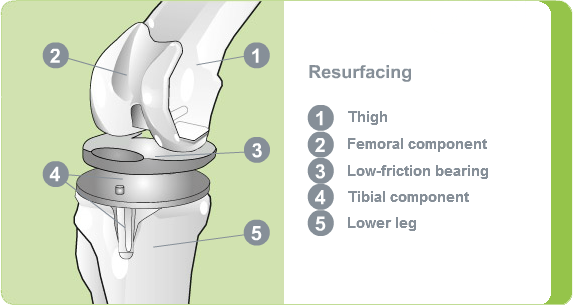 Illustration: Knee resurfacing