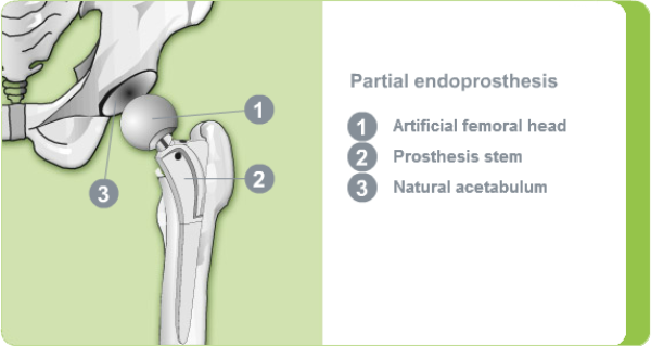 Illustration of a partial hip endoprosthesis