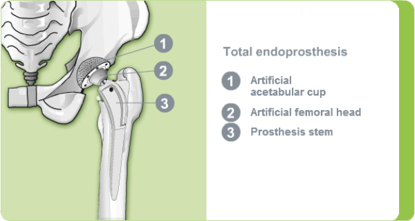 Illustration of a total hip endoprosthesis