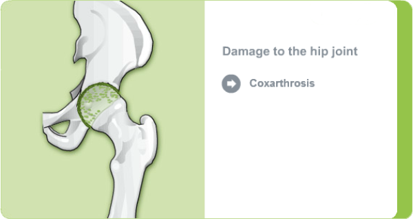 Illustration: Damage to the hip joint due to coxarthrosis