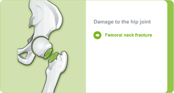 Illustration: Damage to the hip joint due to femoral neck fracture