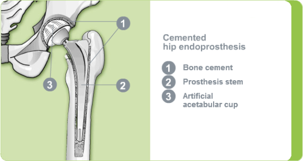Illustration of a cemented hip endoprosthesis