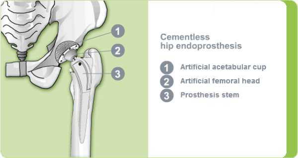 Illustration of a cementless hip endoprosthesis