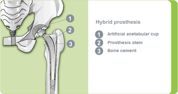 Illustration of a hybrid hip prosthesis