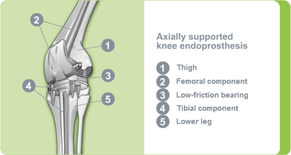 Illustration: Axially supported knee endoprosthesis