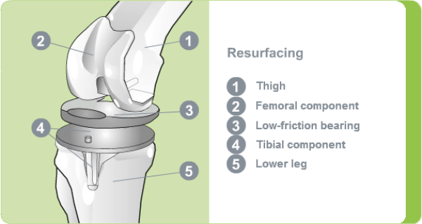 Illustration: Knee resurfacing