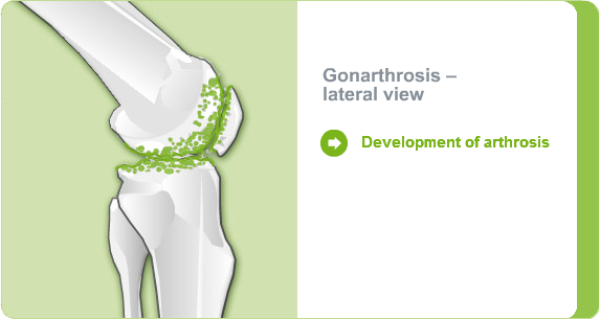 Illustration: Gonarthrosis - lateral view