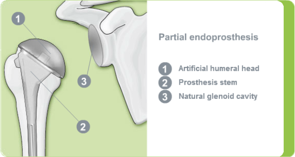 Illustration of a partial shoulder endoprosthesis